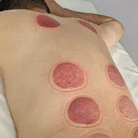 آموزش دوره تخصصی حجامت فصد زالو بادکش|خدمات آموزشی|کرج, کمال‌شهر|دیوار
