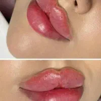 تزریق ژل  فیلرلب و گونه  و چانه مزو در مطب