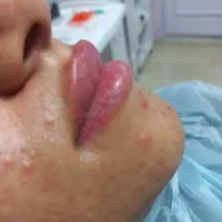 تزریق ژل و بوتاکس و prp صورت و مزو مو|خدمات آرایشگری و زیبایی|سبزوار, جوادیه شرقی|دیوار