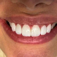 مدل ونیر کامپوزیت