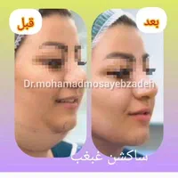 جشنواره ساکشن تخصصی غبغب و تزریق چربی اقساط|خدمات آرایشگری و زیبایی|تهران, شهر زیبا|دیوار