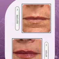 تخفیفات ویژه تزریق ژل،بوتاکس،مزو،نخ هایفو و آراف