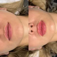 تزریق ژل و بوتاکس|خدمات آرایشگری و زیبایی|هشتگرد, شهرک ولیعصر (مصلی)|دیوار