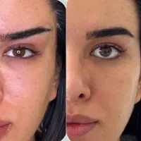 عمل بینی لیفت لیپو ابدو/دایرکت ابرو/رفع غبغب/کاشت|خدمات آرایشگری و زیبایی|کاشان, امیرکبیر|دیوار