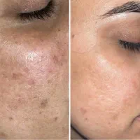 لیزر کیوسوییچ ، پیلینگ کربن ، ریمو تتو