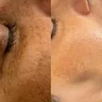 پاککردن تتوی بدن و روشن شدن بیکینی و زیربغل وصورت|خدمات آرایشگری و زیبایی|یاسوج, |دیوار