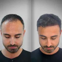 کاشت مو پرتراکم و تضمینی فقط ۱۵ میلیون|خدمات آرایشگری و زیبایی|تهران, جردن|دیوار