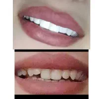 تخفیف کامپوزیت ونیر دندان|خدمات آرایشگری و زیبایی|اردبیل, |دیوار