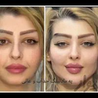 هایفوتراپی/هایفو ساکشن  شکم‌ ابدو /بلفاروپلاستی|خدمات آرایشگری و زیبایی|مشهد, وکیل‌آباد|دیوار