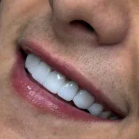 جشنواره کامپوزیت دندان واحدی690|خدمات آرایشگری و زیبایی|کرج, عظیمیه|دیوار