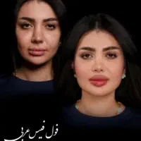 تزریق ژل لب و گونه و چانه.. (جشنواره)درمطب فقط500ت