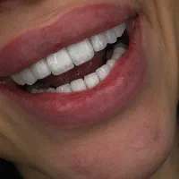 با چک بدون پیش پرداخت کامپوزیت کن
