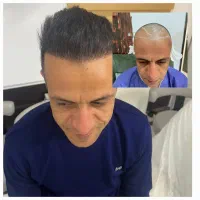 کاشت مو و کاشت ابرو با تراکم بالا و کار تضمینی