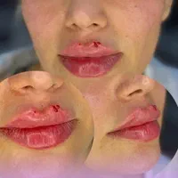 ساکشن شکم پهلو غبغب تزریق چربی ژل بوتاکس|خدمات آرایشگری و زیبایی|کرمانشاه, |دیوار
