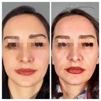 جوانساز دائمی بدون بازگشت