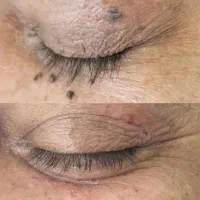 برداشتن خال و زگیل.جوانسازی.بوتاکس.آنزیم.فیلر|خدمات آرایشگری و زیبایی|کرمانشاه, |دیوار