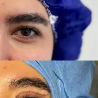 بلفاروپلاستی /پلک پایین پلک بالا