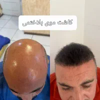 کاشت مو و ابرو طبیعی + پرداخت قسطی|خدمات آرایشگری و زیبایی|ارومیه, |دیوار