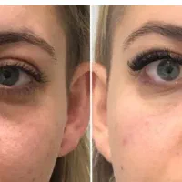 ژل لب روسی،بوتاکس بالیوودی، فیلرزیر چشم،لیفت شقیقه|خدمات آرایشگری و زیبایی|مشهد, سرافرازان|دیوار