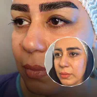 کاشت ابرو با ضمانت نامه کتبی