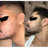 ریش و مو تو با ما پرپشت کن