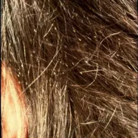 درمان قطعی و تضمینی شپش و تخم شپش بدون بازگشت