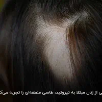درمان ریزش شدید مو|آرایشی، بهداشتی، درمانی|شیراز, نیستان|دیوار