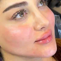 جشنواره تزریق ژل و بوتاکس در مطب با۳۰درصد تخفیف