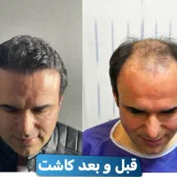 کاشت مو و ابرو|خدمات آرایشگری و زیبایی|رشت, بوسار|دیوار