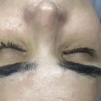 اپیلایسیون کل بدن