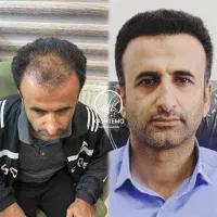 برترین کاشت شقیقه در شیراز|خدمات آرایشگری و زیبایی|شیراز, قصرالدشت|دیوار