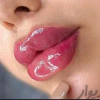 تخفیف ویژه ژل لب فیلرگونه آنزیمprpبوتاکس فیلربادی