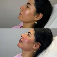جشنواره ژل و بوتاکس و نخ در مطب پزشکی|خدمات آرایشگری و زیبایی|کرج, گلشهر|دیوار