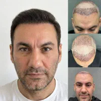 کاشت مو توسط دکتر وفائی اقساط و ضمانت