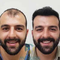 تو‌شهریور کاشت مو‌ هم‌جشنواره هم چکی فقط با ۱۵ ت|خدمات آرایشگری و زیبایی|تهران, جردن|دیوار