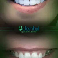 کامپوزیت، لمینت، ایمپلنت اقساط ویژه|خدمات آرایشگری و زیبایی|رشت, ساغری سازان|دیوار