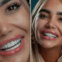 قسطی لمینیت کامپوزیت ایمپلنت دندان پزشکی