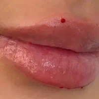 جشنواره ی بهاره فیلر  به تمامی نواحی صورت
