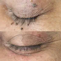 برداشتن انواع خال کک مک لک بادستگاه پیشرفته|خدمات آرایشگری و زیبایی|کازرون, |دیوار