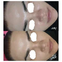 خدمات فیشیال فقط ۲۵۰ مزونیدلینگ کربوکسی تراپی