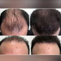 با کچلی خداحافظی کن