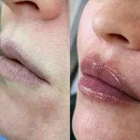 تخفیف فوق العاده خدمات ژل و بوتاکس در مطب|خدمات آرایشگری و زیبایی|شاهینشهر, بوستان حافظ|دیوار