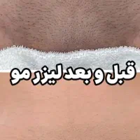 لیزر مو|خدمات آرایشگری و زیبایی|خوی, |دیوار