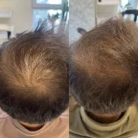 تزریق بوتاکس، فیلر و مزوتراپی توسط پزشک