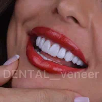 دندانپزشکی کامپوزیت ایمپلنت لمینت  (بدون تراش)|خدمات آرایشگری و زیبایی|تهران, زعفرانیه|دیوار