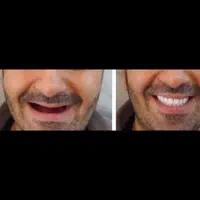 دندانسازی باکیفیت عالی، قیمت مناسب خیابان گرگان|خدمات آرایشگری و زیبایی|تهران, گرگان|دیوار