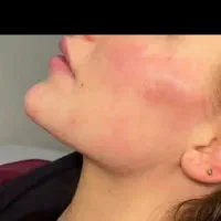 لیزرموزائدتیتانیوم ویژه روز مادر ۵۹۰تومن|خدمات آرایشگری و زیبایی|گرگان, |دیوار