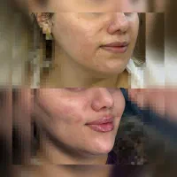 زیبایی نیلگون تخفیف میکروبلیدینگ،فیبروز،فیلر(ژل)