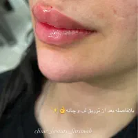 آف فیلر و بوتاکس فقطط۵۸۰|خدمات آرایشگری و زیبایی|ایذه, |دیوار