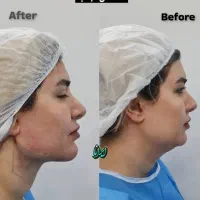 ساکشن غبغب توسط جراح (کلنیک ایرانا)|خدمات آرایشگری و زیبایی|یاسوج, |دیوار